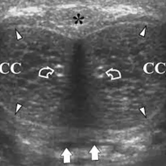 Penile Ultrasound